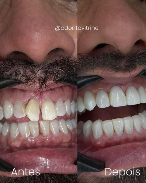 Antes e depois de lentes dentais — Adeus, dentes tortos e espaçados