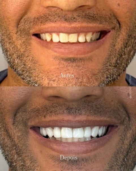 Antes e depois de lentes dentais — A transformação que você sempre quis, em poucas sessões